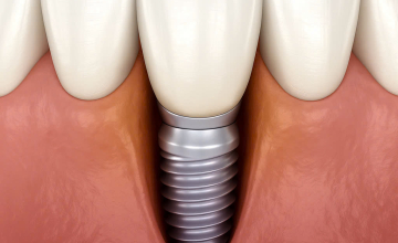 Antibacterial Therapy tại Nha Khoa Smile Hunter: Giảm 90% Biến Chứng Viêm Nhiễm Implant